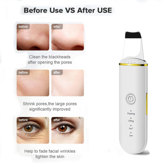 Beauty Ultrasonic Skin Scrubber - 3 Million LLC